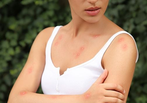 Zaščita pred komarji